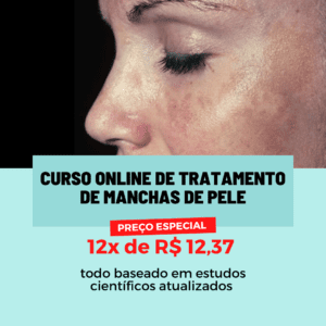 Clareamento de melasma