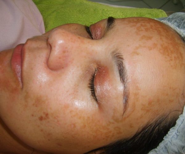 O que é o melasma? Saiba tudo!