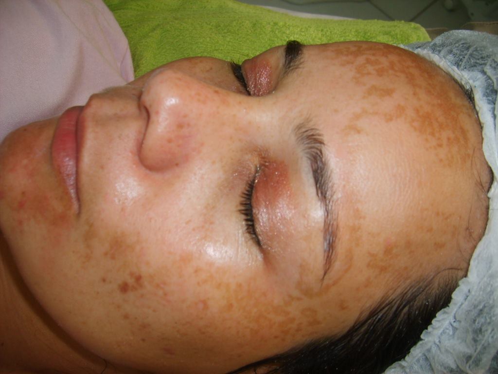 No momento, você está visualizando O que é o melasma? Saiba tudo!
