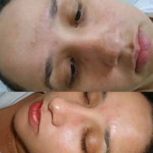 Leia mais sobre o artigo 4 opções para o tratamento do clareamento do melasma.