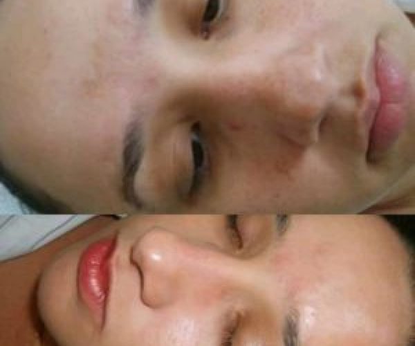 4 opções para o tratamento do clareamento do melasma.