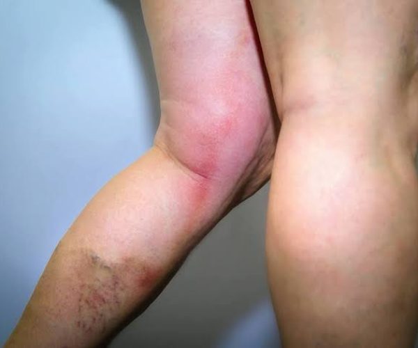 Porque quem tem trombose não pode fazer massagem?