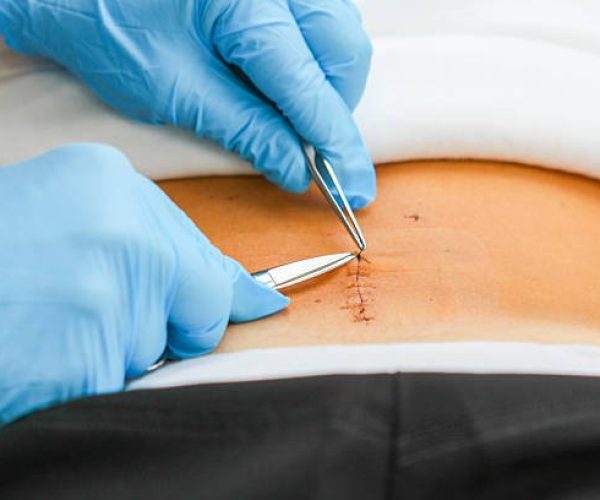 Como prevenir a necrose