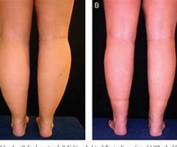 Como tratar o Lipedema