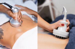 Leia mais sobre o artigo Diferença de criofrequência e radiofrequência