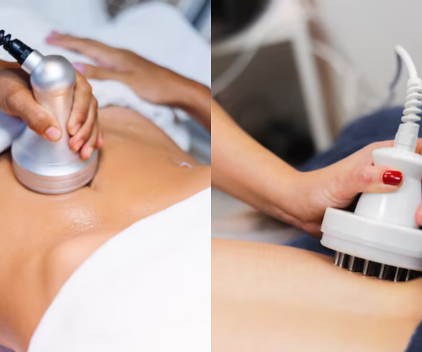 Diferença de criofrequência e radiofrequência