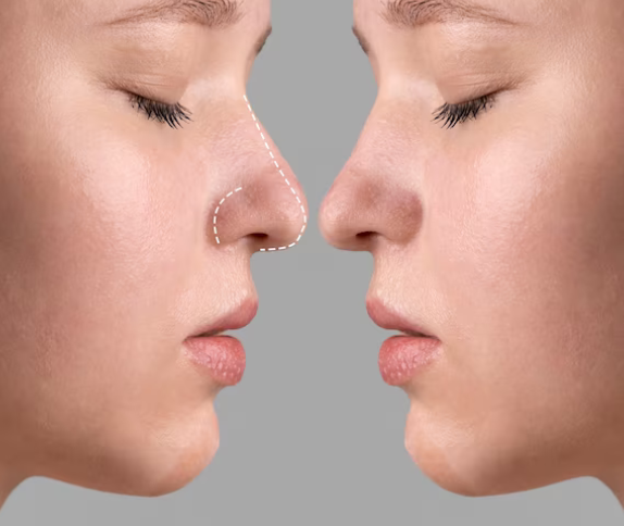 No momento, você está visualizando Rinoplastia- Cuidado no pós operatório