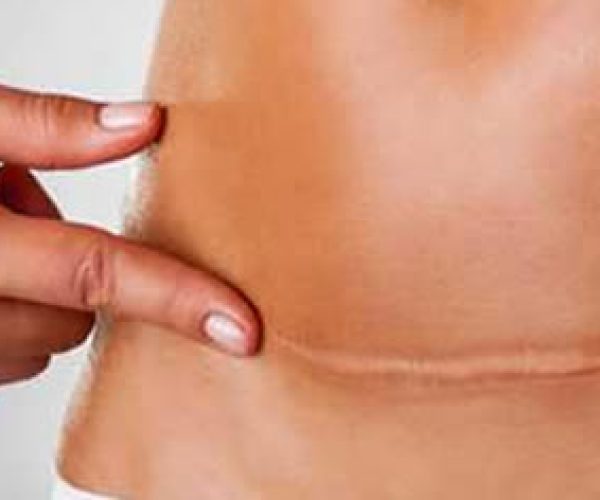 Quais as fases da cicatrização da cirurgia estética?