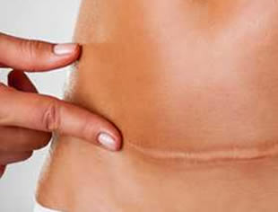 No momento, você está visualizando Quais as fases da cicatrização da cirurgia estética?