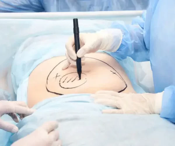 Como se forma o seroma no pós operatório e como tratar?