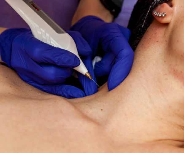 O que o endolifting e seus benefícios