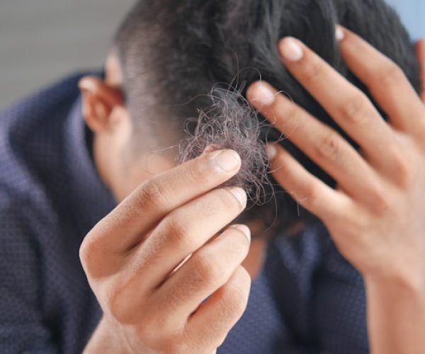 Como acontece a alopecia e quais os tratamentos indicados